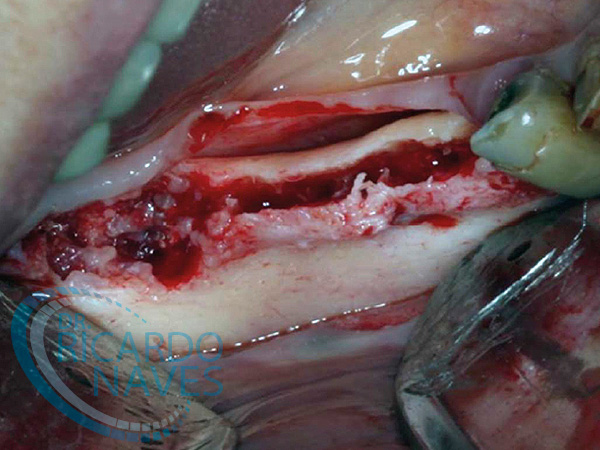 Técnica de separación de reborde Alveolar o Split