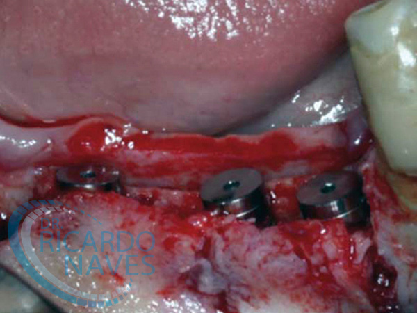 Técnica de separación de reborde Alveolar o Split