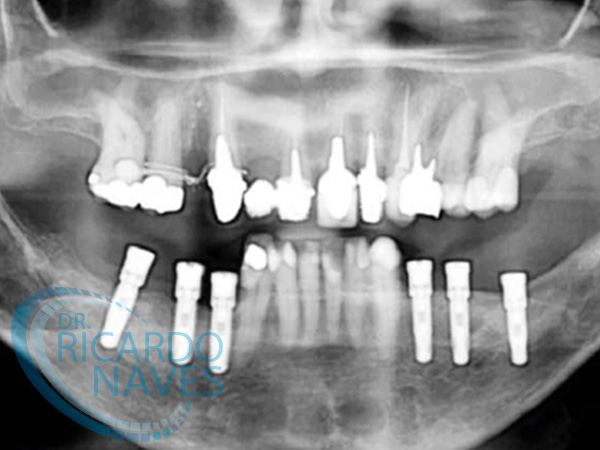 Técnica de separación de reborde Alveolar o Split