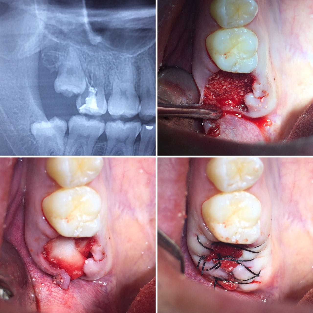 Preservación alveolar post exodoncias