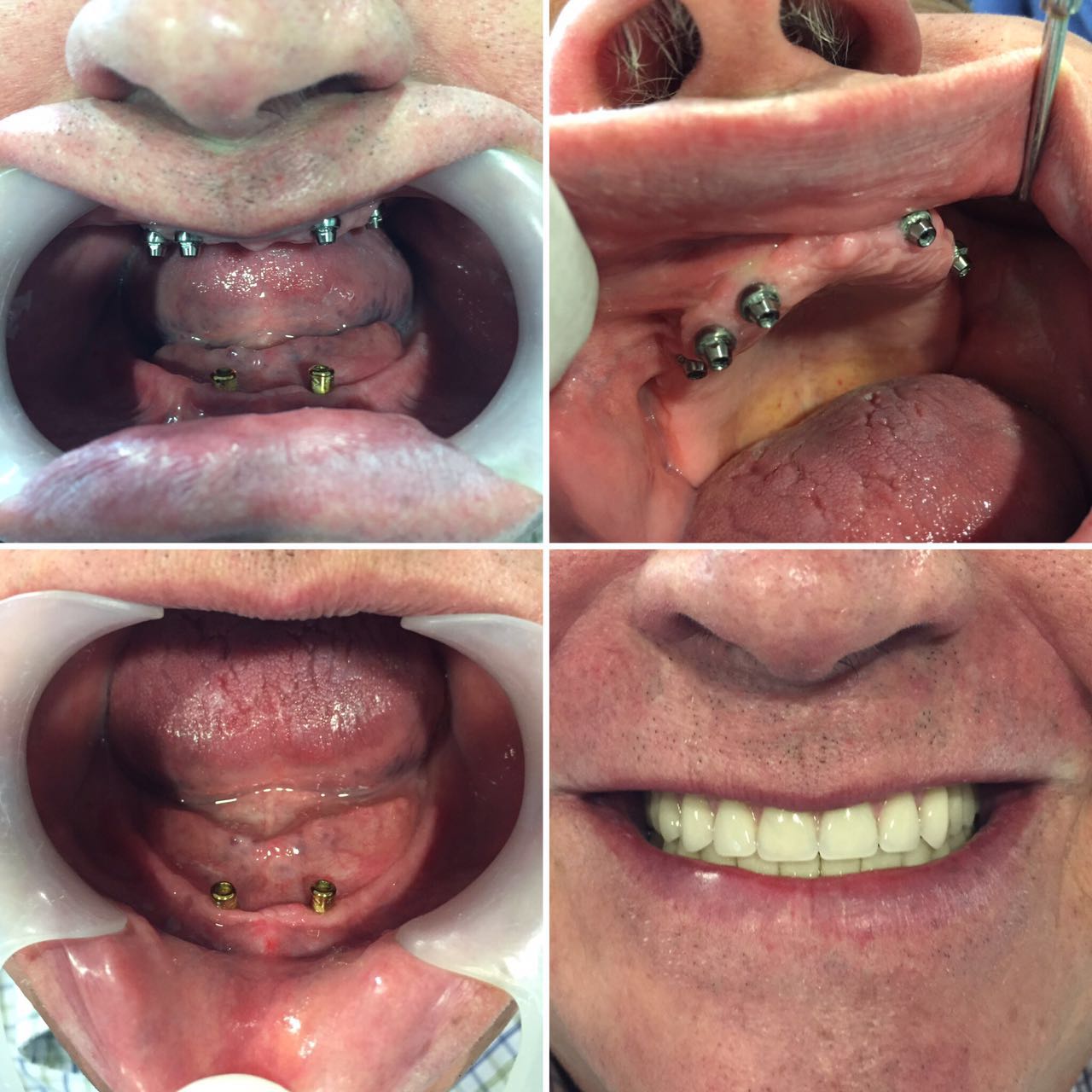 Prótesis dentogingival sobre implantes 