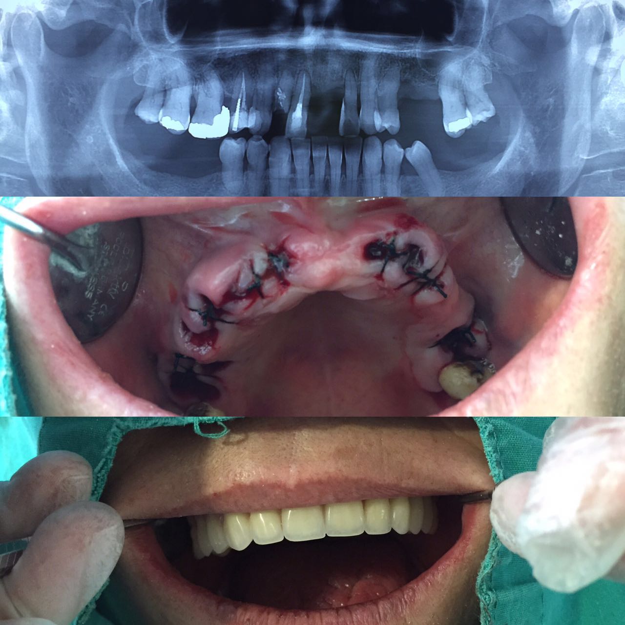 Exodoncias multiples