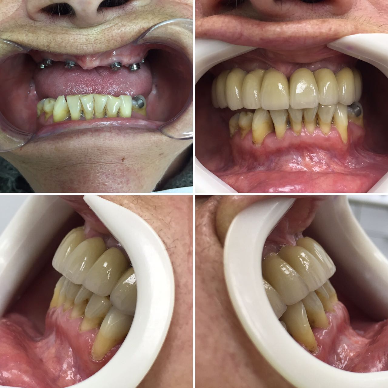 Preservación alveolar post exodoncias