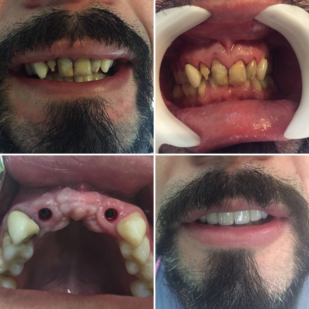 Preservación alveolar post exodoncias